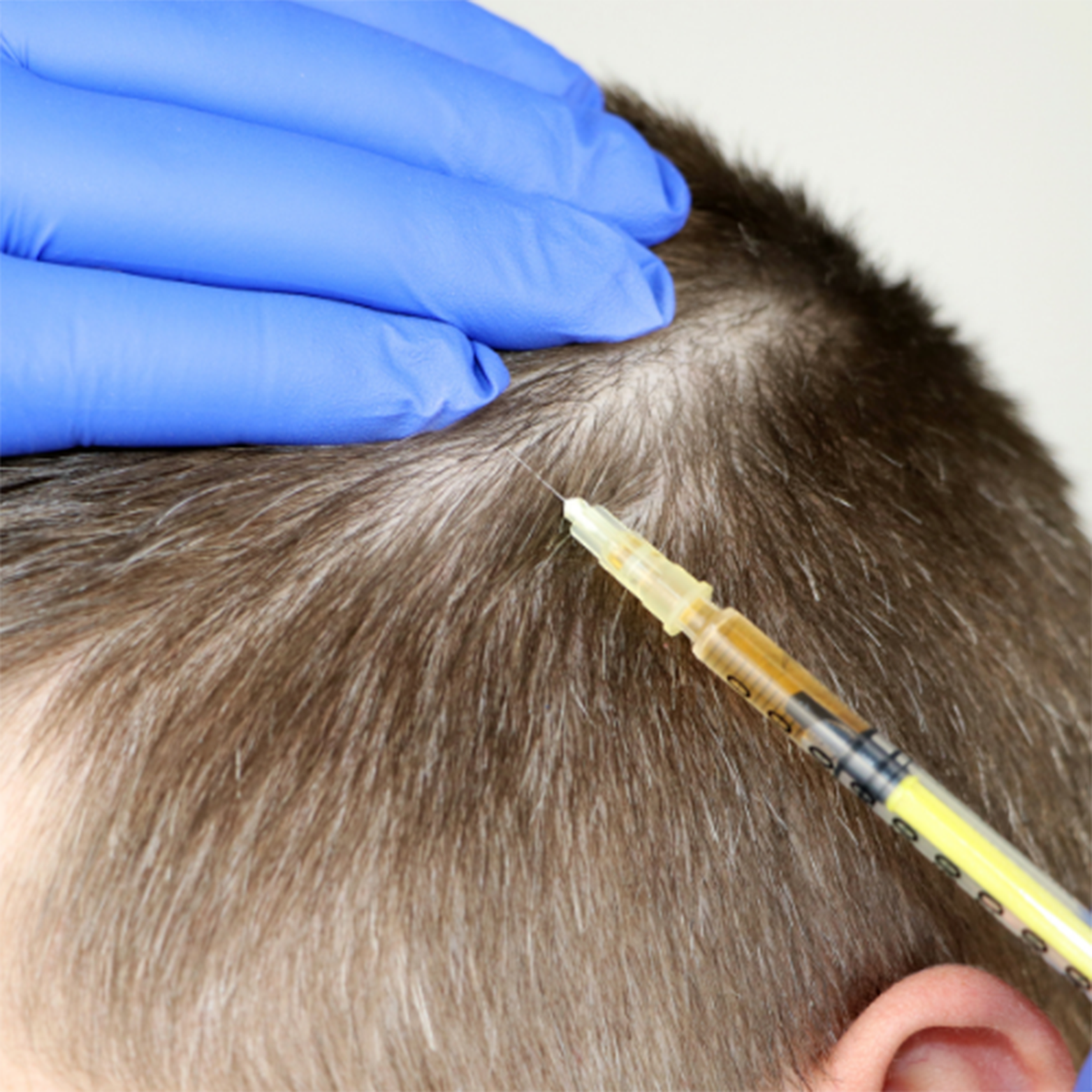 Complication Insure covers expenses related to problems that could be associated with hair transplantation procedures.